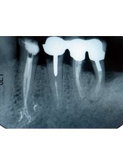 Premolar Root Canal - Dental Cosmetic & Implant Centre