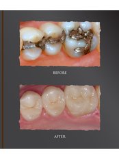 Permanent Crown - Dental Cosmetic & Implant Centre