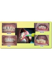 Scaling and Root Planing - Dental Cosmetic & Implant Centre