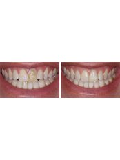 Porcelain Inlay or Onlay - Dental Cosmetic & Implant Centre