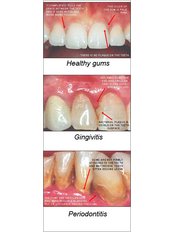 Periodontitis Treatment - Dental Cosmetic & Implant Centre