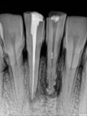 Incisor Root Canal - Dental Cosmetic & Implant Centre