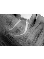 Complex Root Canal - Dental Cosmetic & Implant Centre