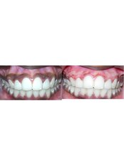 Gum Surgery - Dental Cosmetic & Implant Centre