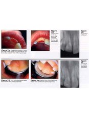 Pulpotomy - Dental Cosmetic & Implant Centre