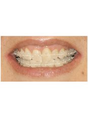 Six Month Smiles™ - Dental Cosmetic & Implant Centre