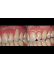 Soft Tissue Grafts - Dental Cosmetic & Implant Centre