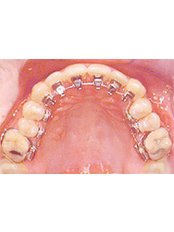 Lingual Braces - Dental Cosmetic & Implant Centre