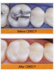 Composite Resin Inlay or Onlay - Dental Cosmetic & Implant Centre