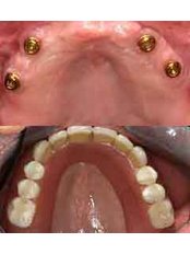 Implant Bridge - Dental Cosmetic & Implant Centre