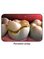 Porcelain Inlay or Onlay - Dental Cosmetic & Implant Centre