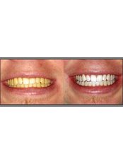 BriteSmile™ Teeth Whitening - Dental Cosmetic & Implant Centre