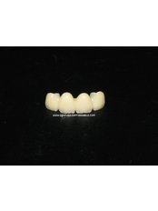 Fixed Partial Dentures - Dental Cosmetic & Implant Centre