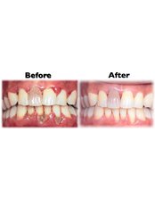 Scaling and Root Planing - Dental Cosmetic & Implant Centre