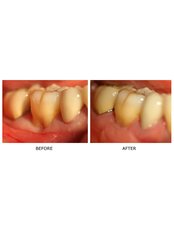 Soft Tissue Grafts - Dental Cosmetic & Implant Centre