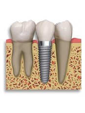 Dental Implants - Dental Cosmetic & Implant Centre