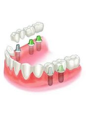 Implant Bridge - Dental Cosmetic & Implant Centre
