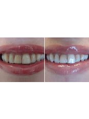 Chemical Teeth Whitening - Dental Cosmetic & Implant Centre