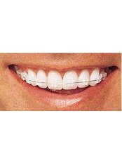Clear Braces - Dental Cosmetic & Implant Centre