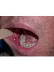 Oral Cancer Treatment - Dental Cosmetic & Implant Centre
