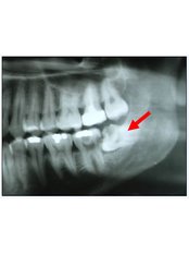 Wisdom Tooth Extraction - Dental Cosmetic & Implant Centre
