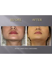 Jaw Contouring - Dental Cosmetic & Implant Centre