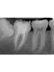 Molar Root Canal - Dental Cosmetic & Implant Centre