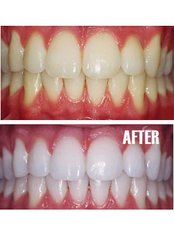 Teeth Whitening - Dental Cosmetic & Implant Centre
