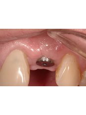 Single Implant - Dental Cosmetic & Implant Centre