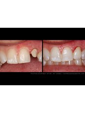 Resin Crown - Dental Cosmetic & Implant Centre