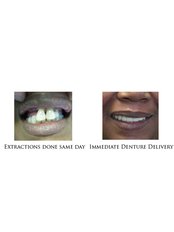 Immediate Dentures - Dental Cosmetic & Implant Centre