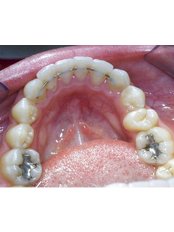 Orthodontic Retainer - Dental Cosmetic & Implant Centre