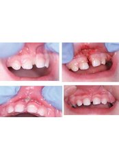 Lingual Frenectomy - Dental Cosmetic & Implant Centre