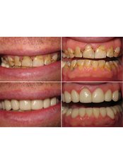 Porcelain Veneers - Dental Cosmetic & Implant Centre