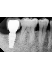 Single Implant - Dental Cosmetic & Implant Centre