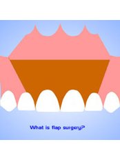 Gingival Flap Surgery - Dental Cosmetic & Implant Centre
