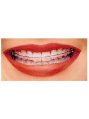 Ceramic Braces - Dental Cosmetic & Implant Centre