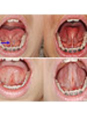 Lingual Frenectomy - Dental Cosmetic & Implant Centre
