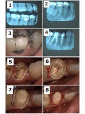 Premolar Root Canal - Dental Cosmetic & Implant Centre