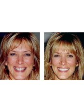 Gum Contouring and Reshaping - Dental Cosmetic & Implant Centre