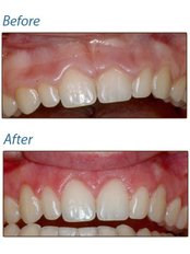Gum Contouring and Reshaping - Dental Cosmetic & Implant Centre