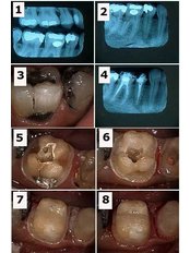 Resin Crown - Dental Cosmetic & Implant Centre