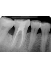 GTR - Guided Tissue Regeneration - Dental Cosmetic & Implant Centre