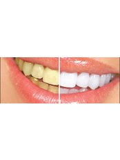 Chemical Teeth Whitening - Dental Cosmetic & Implant Centre