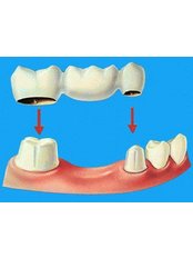 Dental Bridges - Dental Cosmetic & Implant Centre