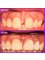 Jaiswal Dental Clinic - Frenectomy + Diastema Closure 