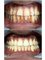 Jaiswal Dental Clinic - Ultrasonic scaling 