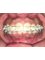Nagpur Dentist Orthodontics & Dental Implants - Damon Braces _ Clear 