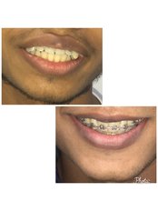 Nagpur Dentist Metal Braces - Nagpur Dentist Orthodontics & Dental Implants