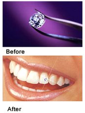 Tooth Jewellery - Priyanshu Dental Hospital